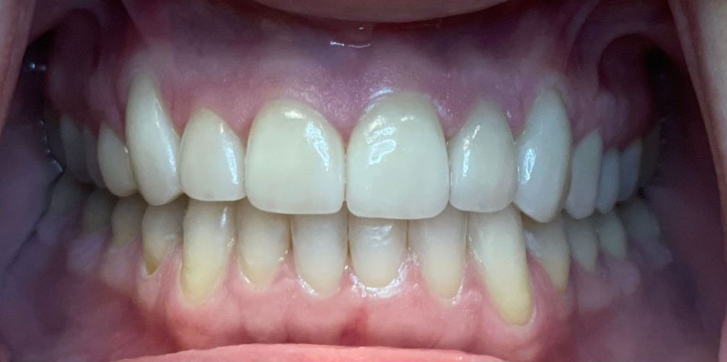 Before & After Colored Fillings