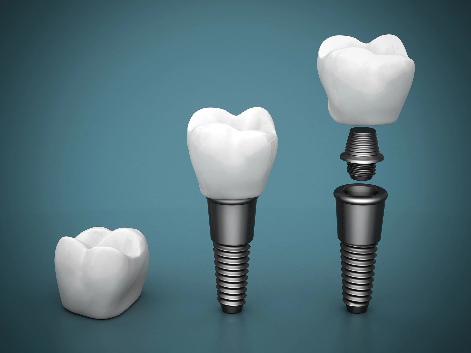 Dental Implants in Bolingbrook, IL