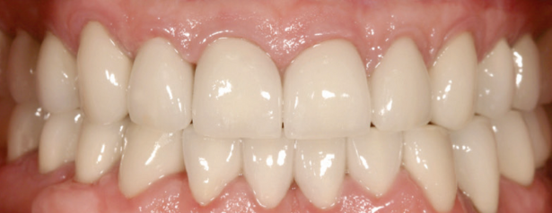 Dental Bridges & Dental Crowns After