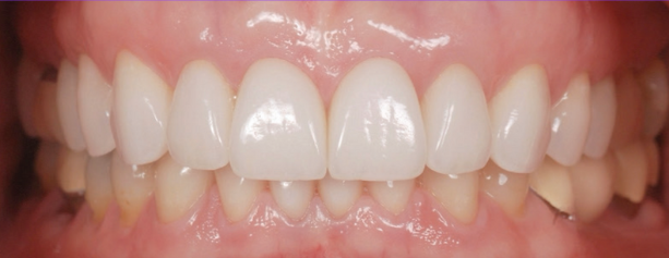 Smile Makeover with Veneers After