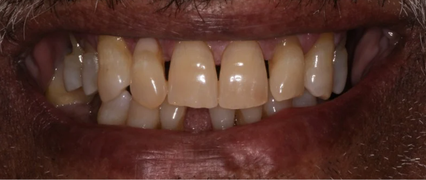 All-on-6 Implants Before