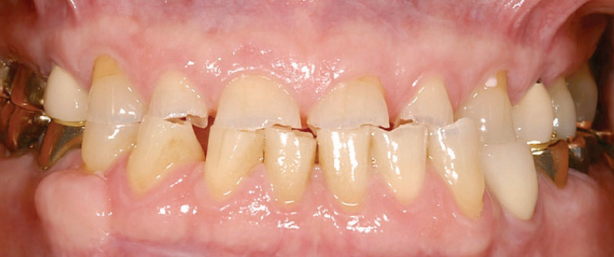 Dental Bridges & Dental Crowns Before