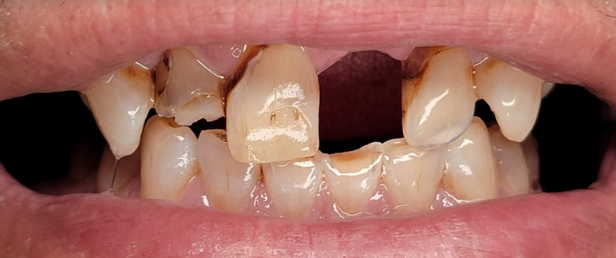 Dental Implants Before